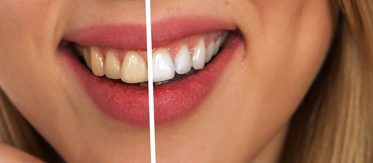 Whitened Your Teeth Recently? Tips from Your Cosmetic Dentist to Maintain them Perfectly!