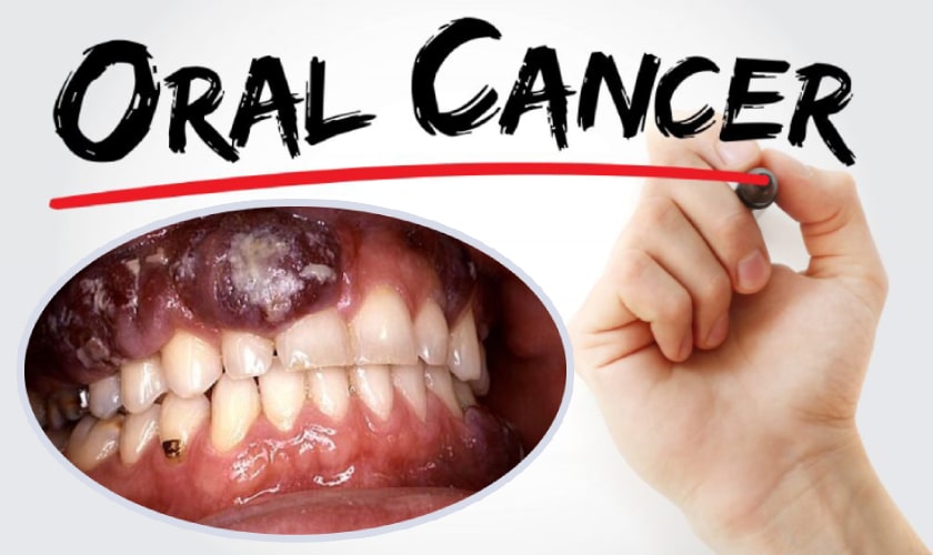 Oral Cancer: Causes and Symptoms
