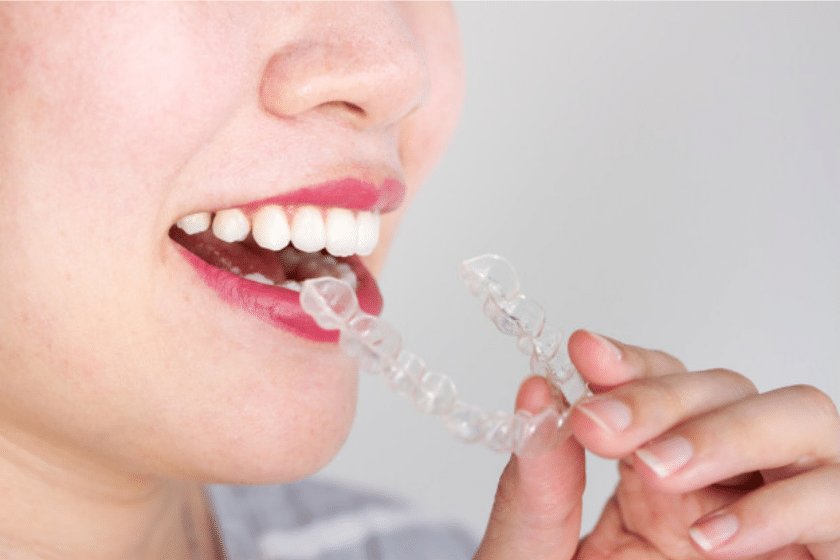 Achieve the Perfect Smile with Invisalign Treatment