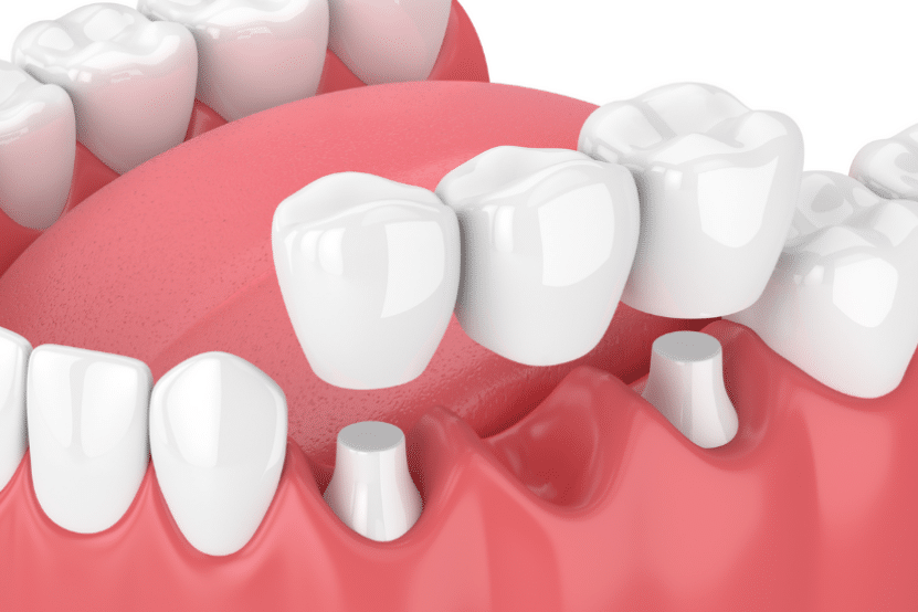 How Dental Bridges Can Help in Restoring Teeth Functionality
