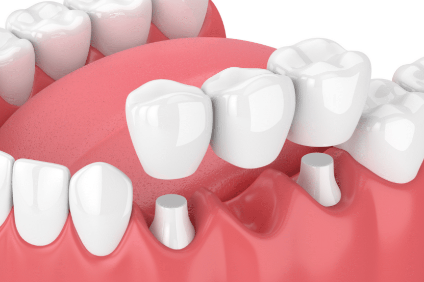 dental bridge img