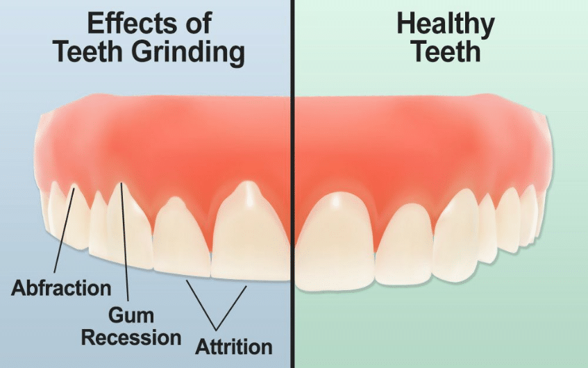 teeth grinding treatment