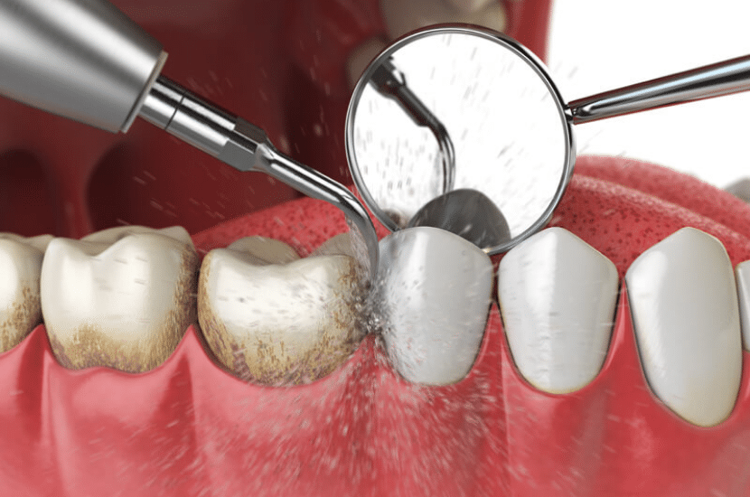 Steps Involved In Periodontal Treatment