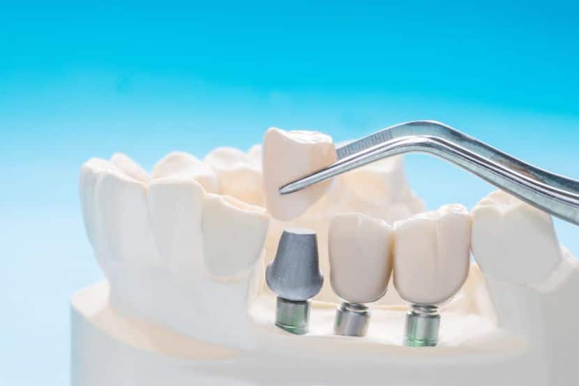 Dental Implants in Cypress TX