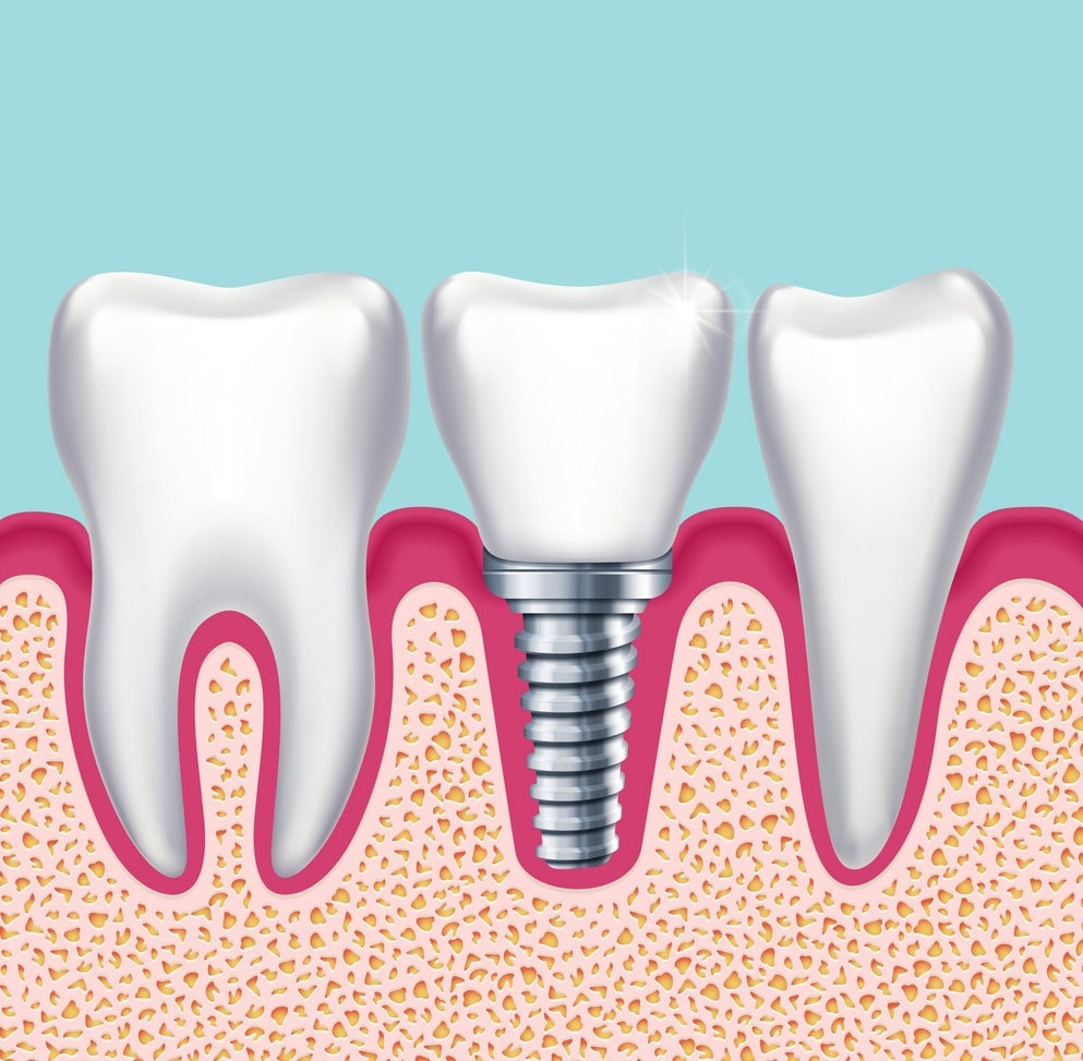 dental implants