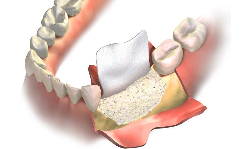 WHAT IS THE ROLE OF BONE GRAFTING IN THE DENTAL FIELD?