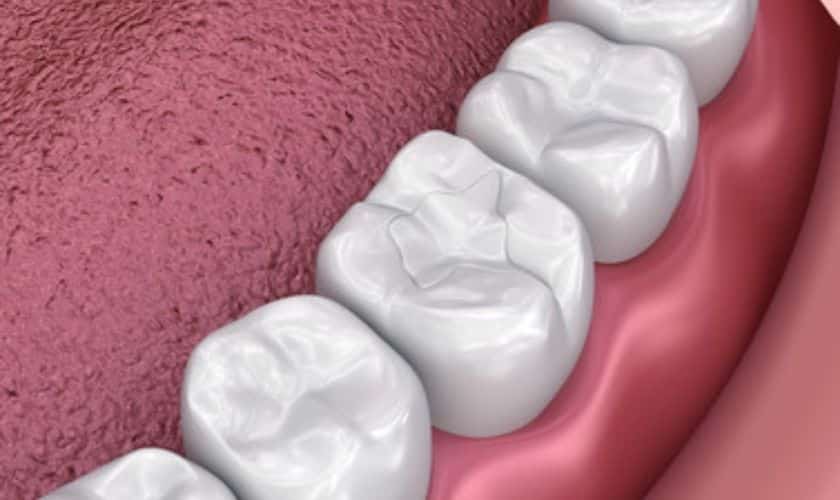 TIPS FOR YOU TO FOLLOW DURING BROKEN OR LOOSE FILLINGS!