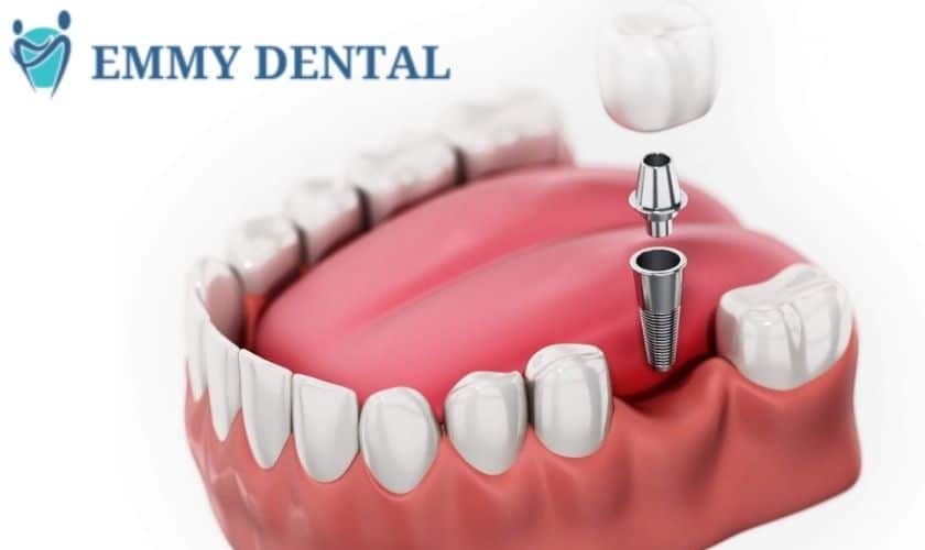 Are Dental Implant Surgery Painful?