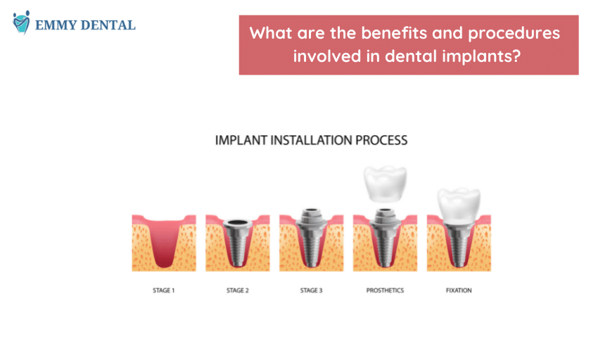 Dental Implants Cypress