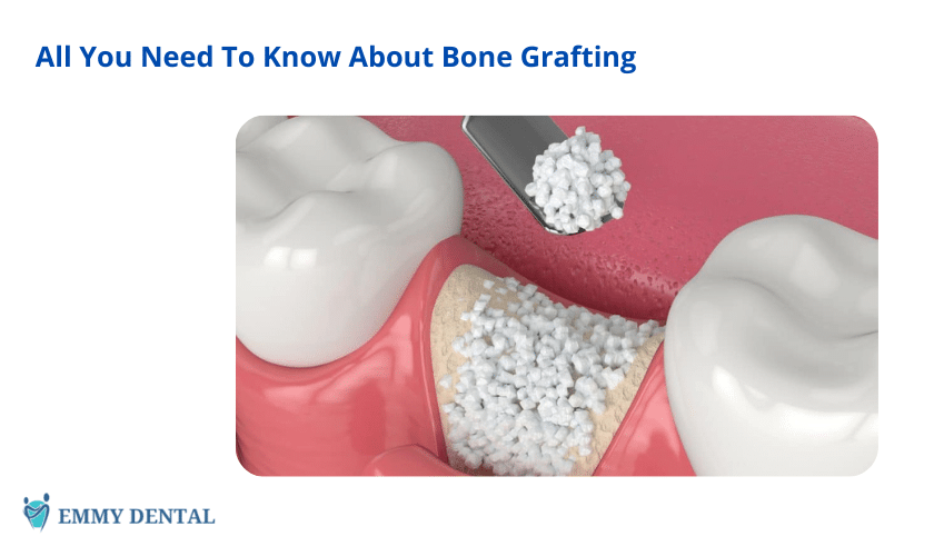 All You Need To Know About Bone Grafting