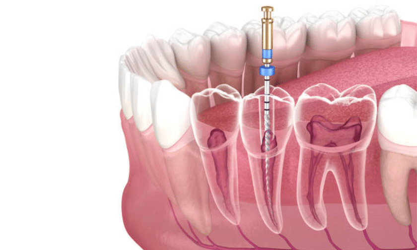 7 Common Signs You Need a Root Canal