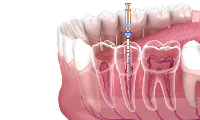 Root Canal