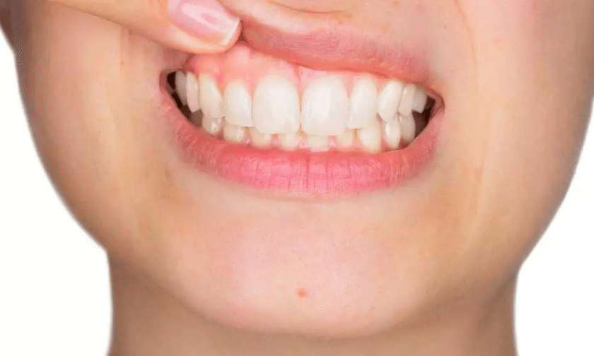 Gum Disease Affect the Heart