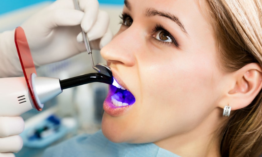 dental sealants