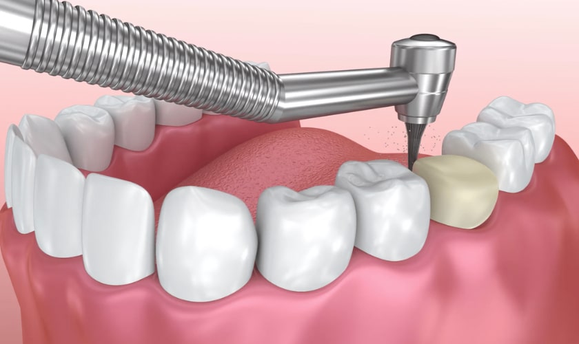 Porcelain Crowns