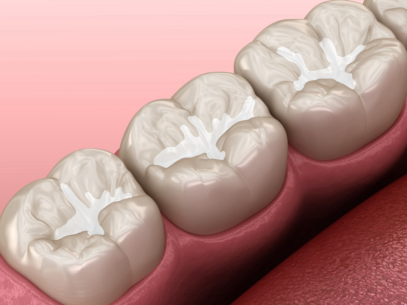 A close-up image of dental sealants applied to a tooth's surface, providing a protective barrier against cavities.