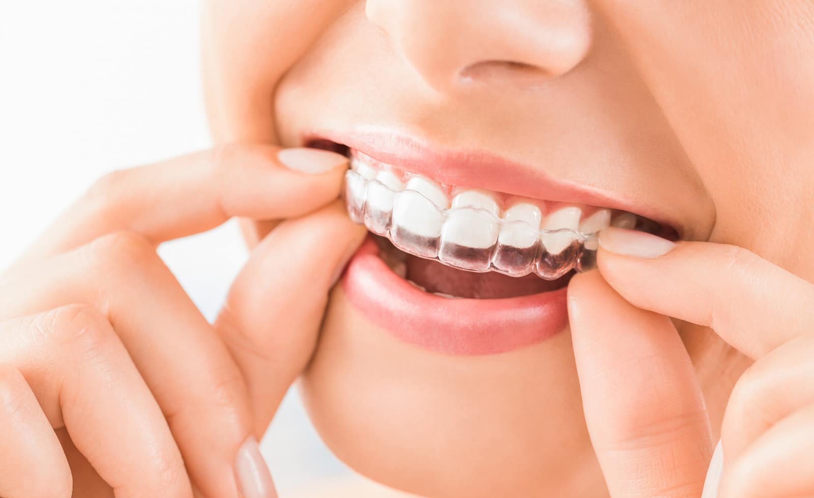 Invisalign in Cypress TX, Emmy Dental Of Cypress