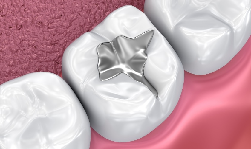 Dental Sealants in Cypress TX