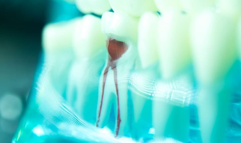 Root Canal Therapy in Cypress TX