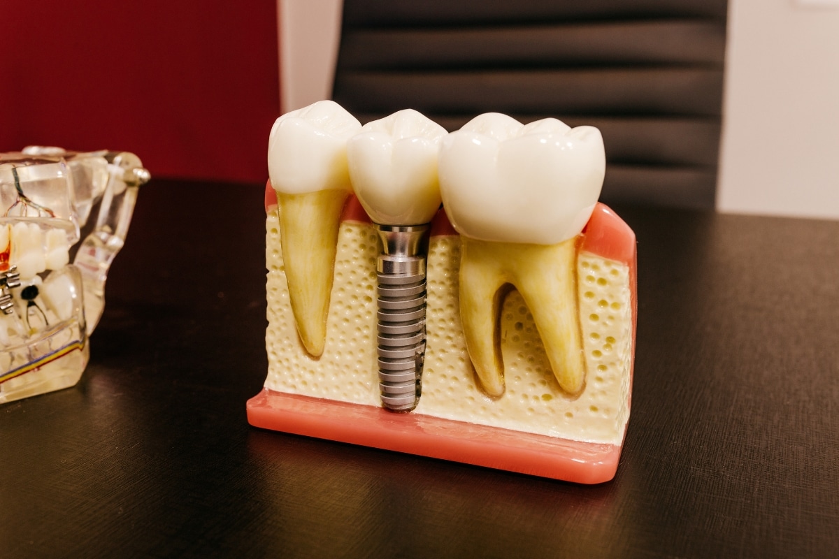 Featured image for “How Long Do Dental Implants Last? A Maintenance Guide for Lifelong Success”