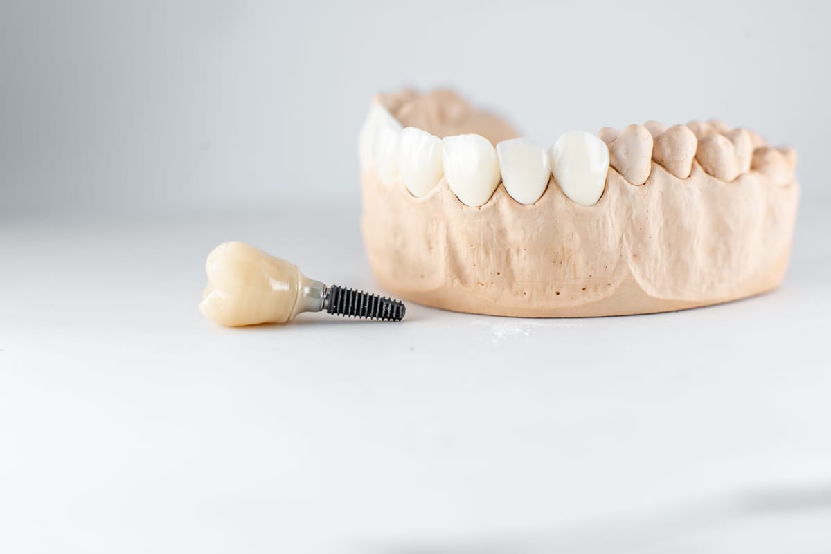 Dental Implants in Cypress